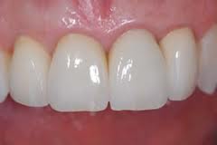 ricostruzione ceramica odontoiatrico clinico impianti dentali